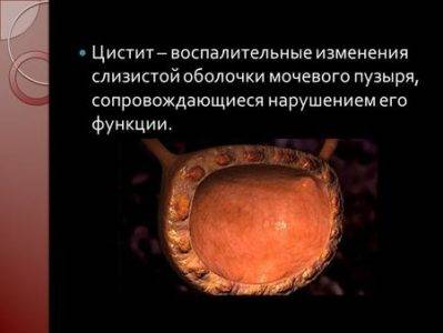 Швидка допомога при циститі препарати і процедури, які знімуть біль