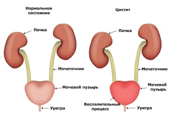 shvidka dopomoga pri cistit v domashn h umovah znebolyuyuch l ki 2 - Швидка допомога при циститі в домашніх умовах: знеболюючі ліки