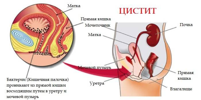 Симптоми циститу після алкоголю – Цистит