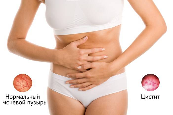 Симптоми циститу після алкоголю – Цистит
