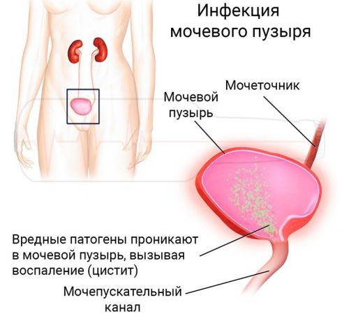 Симптоми циститу після алкоголю – Цистит