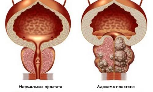 Скільки днів лікується цистит у жінок антибіотиками Скільки днів лікується цистит у жінок антибіотиками