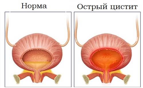 Скільки потрібно лікувати цистит – Цистит