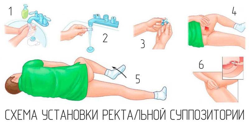 Свічки при циститі: види свічок та їх ефективність