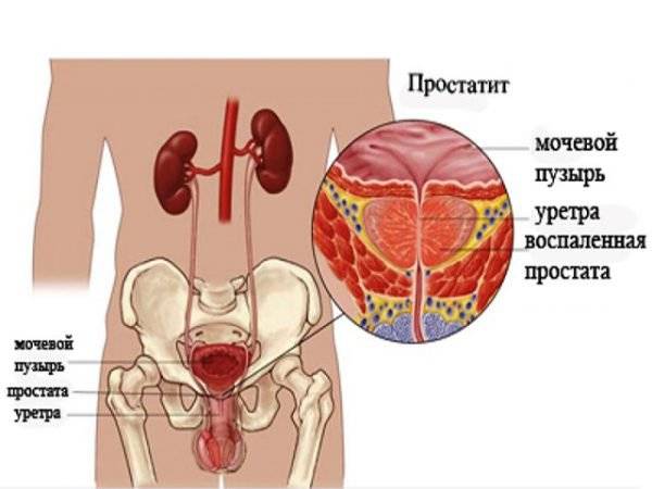Умови при яких передатся цистит