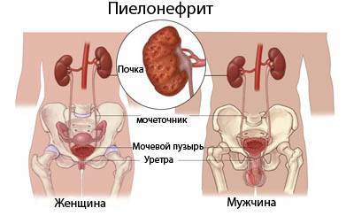 Урологічні антибіотики при циститі і пієлонефриті