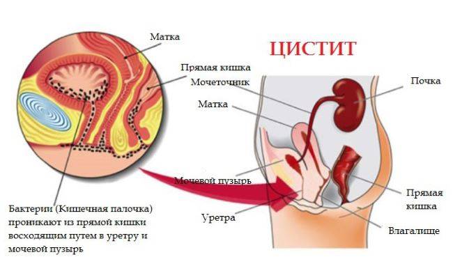 Урологія як передається цистит