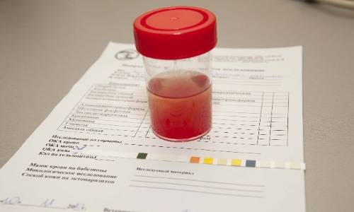 Ускладнення циститу як називається цистит з кров&rsquo;ю Захворювання