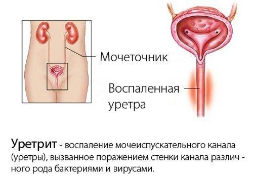 В чс відмінності циститу від уретриту