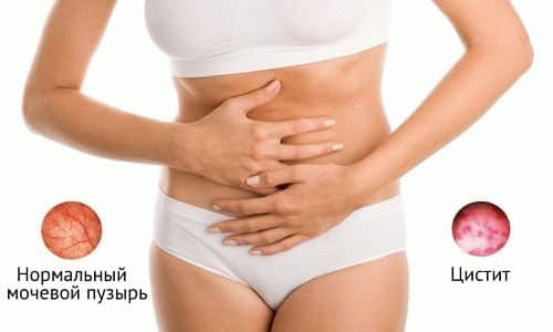 Відмінності уретриту і циститу лікування симптоми локалізація причини діагностика профілактика ускладнення