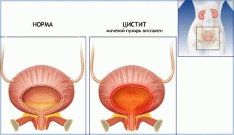 Відмінності уретриту і циститу лікування симптоми локалізація причини діагностика профілактика ускладнення