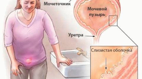 Відмінності уретриту і циститу лікування симптоми локалізація причини діагностика профілактика ускладнення