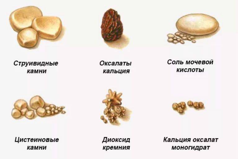 Відміну від циститу сечокам’яної хвороби