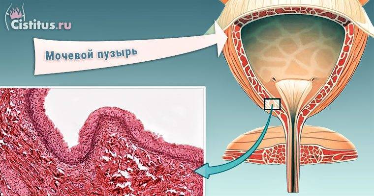 Види циститу у жінок: класифікація циститів