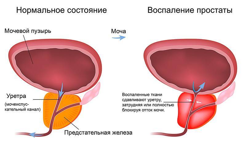 Які аналізи здають при циститі