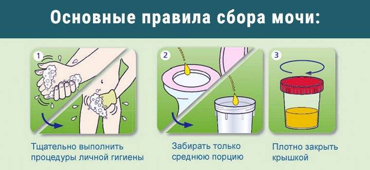 Які аналізи здають при циститі