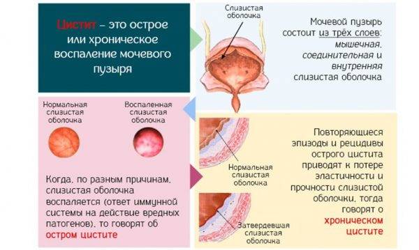 Які антибіотики можна при лактації при циститі Які антибіотики можна при лактації при циститі
