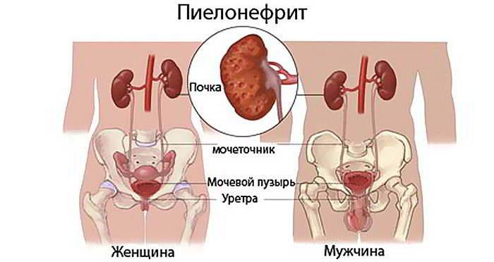 Як цистит переходить в пієлонефрит