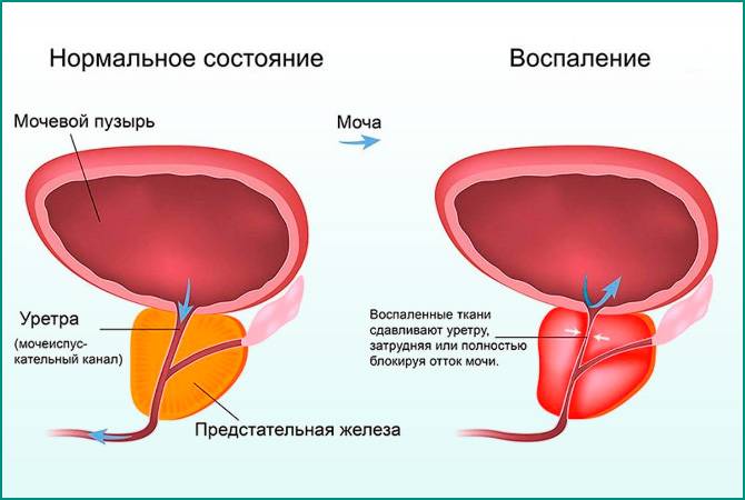 Як довго лікується цистит у жінок як прискорити процес лікування