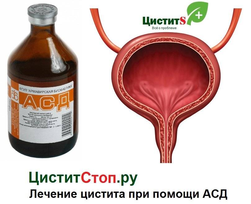 Як лікувати цистит асд – Цистит