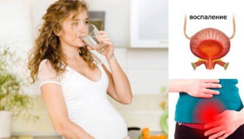 Як лікувати цистит при вагітності на ранніх термінах в домашніх умовах