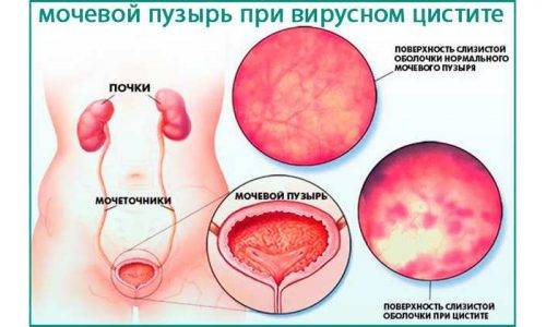 Як лікувати вірусний цистит – Цистит