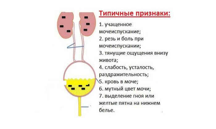 Як лікувати вірусний цистит – Цистит Як лікувати вірусний цистит – Цистит
