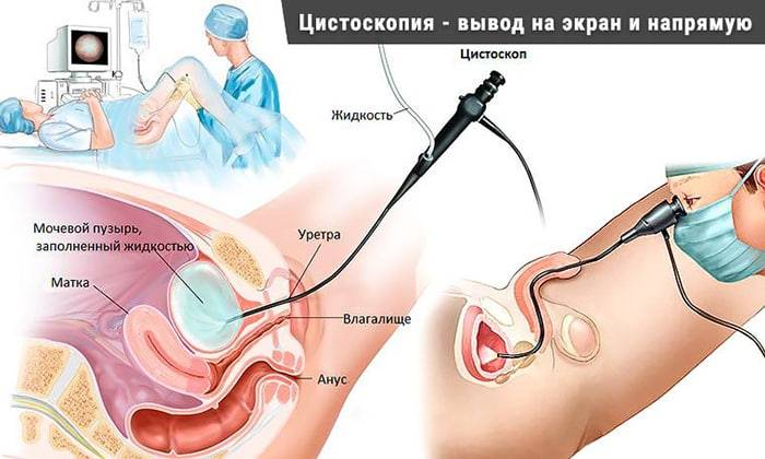 Як лікувати вірусний цистит – Цистит Як лікувати вірусний цистит – Цистит