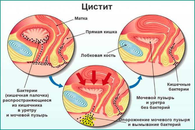 Які можуть бути наслідки після циститу