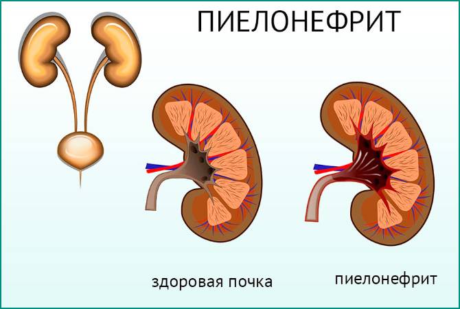Які можуть бути наслідки після циститу