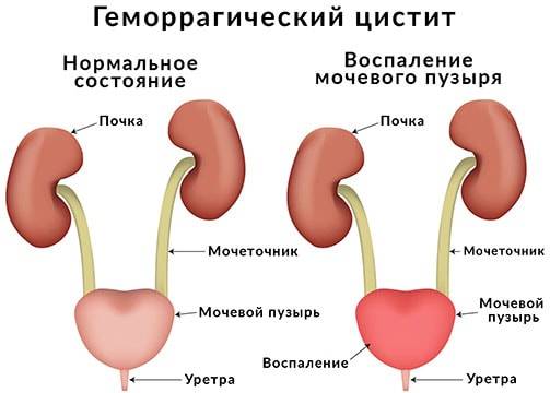 Як відбувається лікування в стаціонарі геморагічного циститу