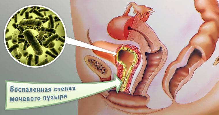 Як відбувається лікування в стаціонарі геморагічного циститу