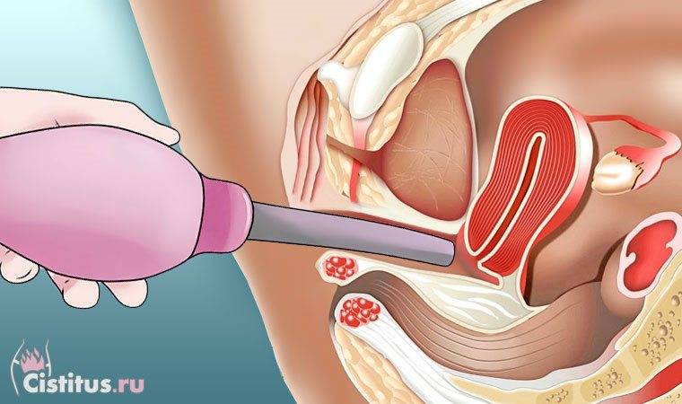 Якими травами спринцюватися від циститу