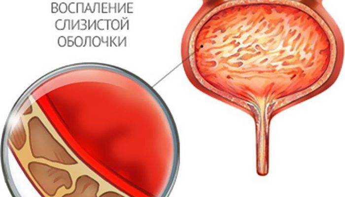 Який антибіотик краще при циститі дитині