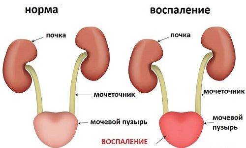 За який час можна вилікувати цистит