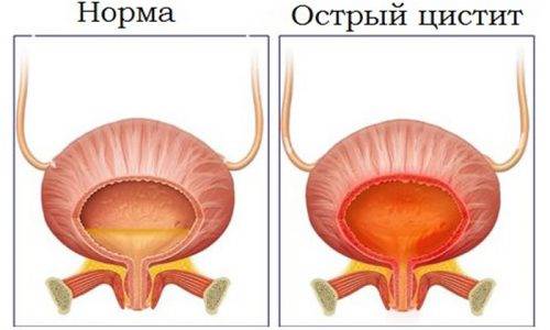 Застосування таблеток з журавлиною від циститу Застосування таблеток з журавлиною від циститу