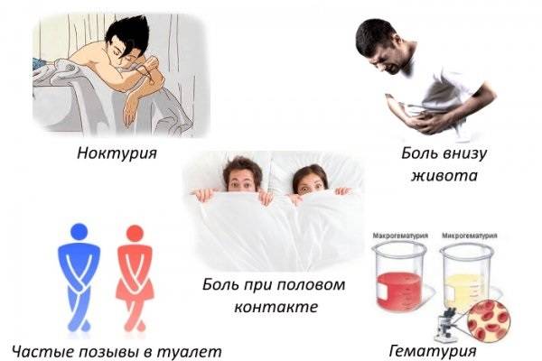 cistit z krov yu pri sechovipuskann l kuvannya ta prichini 1 - Цистит з кров’ю при сечовипусканні лікування та причини